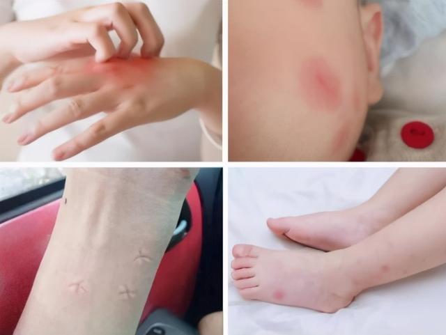 而且我们给孩子挠痒痒之后还容易让蚊子包更加肿胀,所以冰镇方法要收