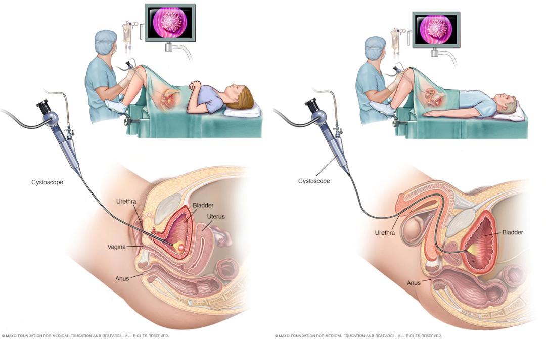 体检发现膀胱里的 葡萄 我收到了来自肿瘤的好人卡 新浪科技 新浪网
