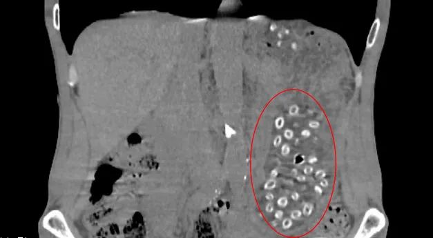 生吞近200颗！胃里密密麻麻…男子紧急送医后竟查出恶性肿瘤，医生：别再这样吃了休闲区蓝鸢梦想 - Www.slyday.coM