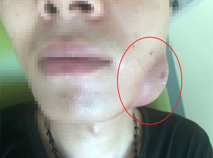 小伙下颌长出超大脓肿,竟是因为它!这类人群要注意了!