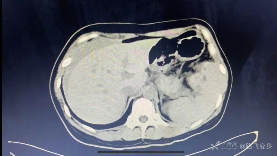 两张片子对比,最明显的改变是脾脏周围有异常混杂密度影,肝周积液,又