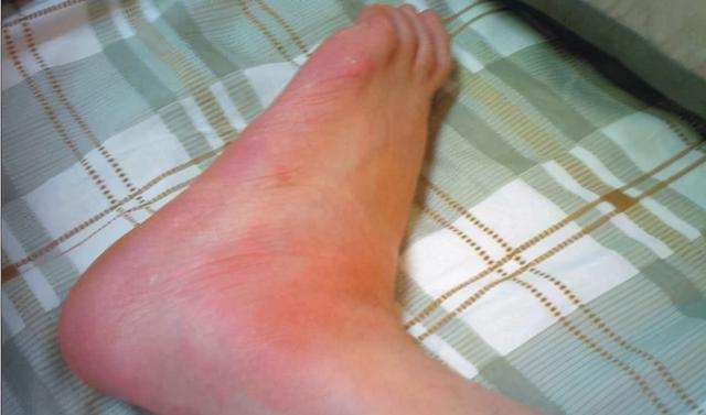 痛风高尿酸血症的人每天喝一杯柠檬水能降尿酸看看医学结果