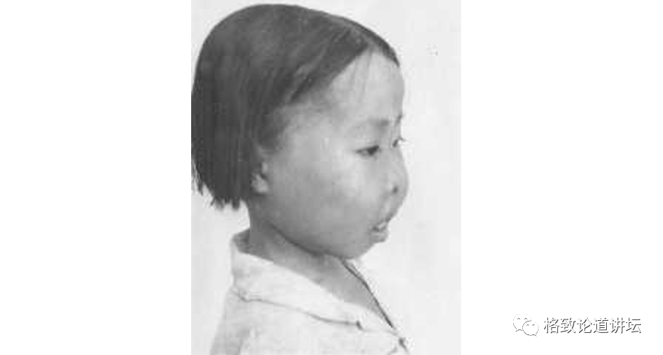 地贫儿童的脱贫希望将治愈率从50提高到97