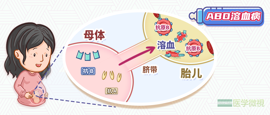 新生儿溶血病_新浪新闻
