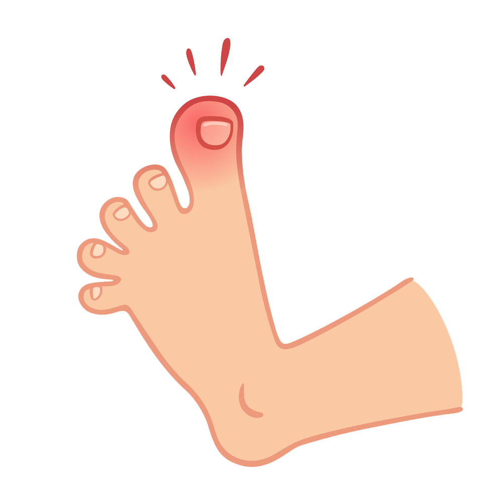 甲沟炎这种溢出屏幕的疼痛那恨不得要把脚趾头截掉才痛快如果不小心