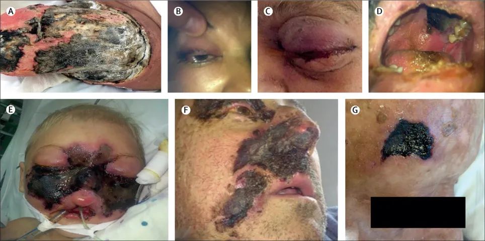 印度新冠疫情之下,这个帮凶让现状雪上加霜|霉菌|印度|新冠肺炎_新浪