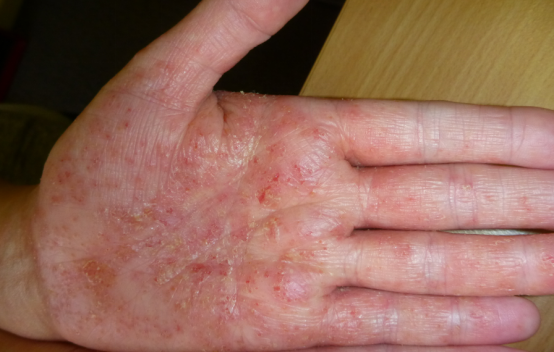 亲爱的医生说我对家务过敏你说怎么办健康日历