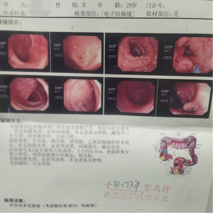 肠结核图片 肠镜检查图片