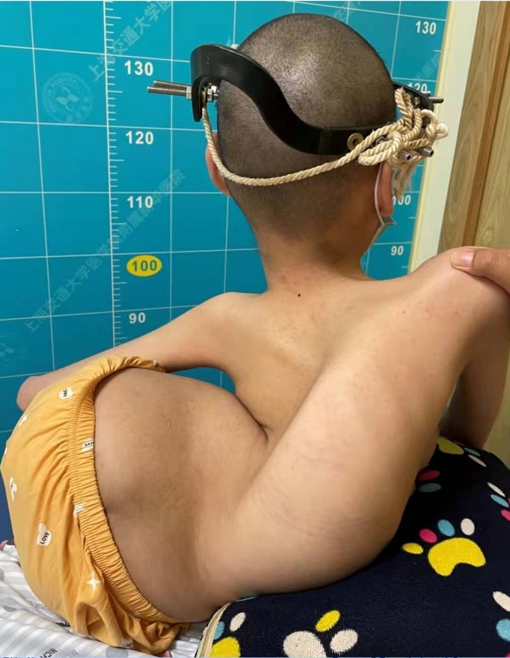 "罕见病女孩母亲的这句话,让人看哭……|脊柱侧弯_新浪新闻