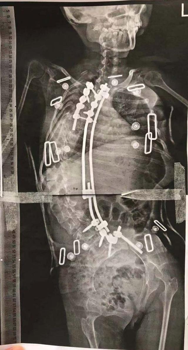 13岁女孩脊柱侧弯176°:说话不成句 医生预期生命5岁休闲区蓝鸢梦想 - Www.slyday.coM