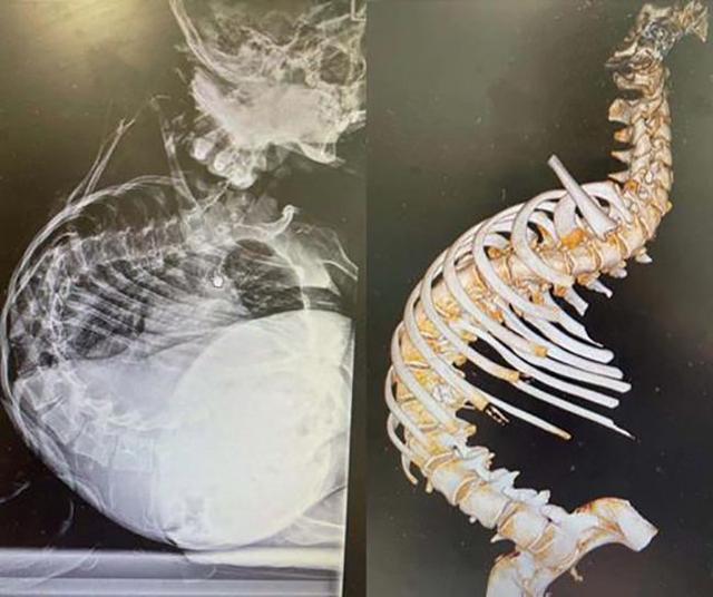 13岁女孩脊柱侧弯176°:说话不成句 医生预期生命5岁休闲区蓝鸢梦想 - Www.slyday.coM