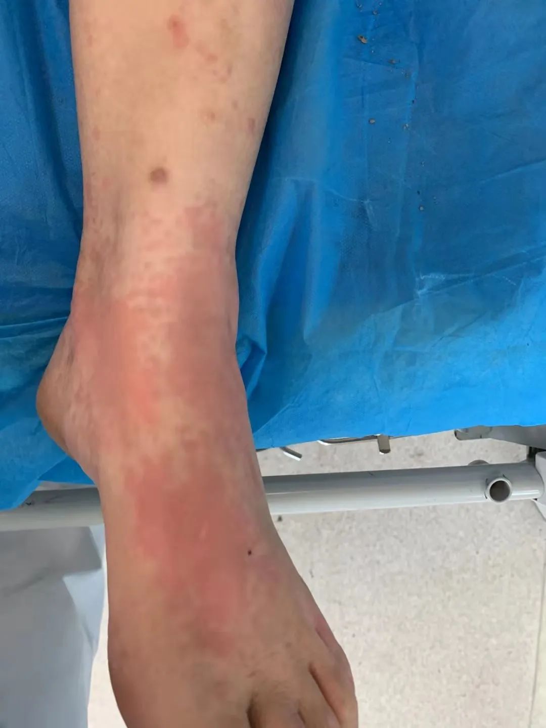 俩阿姨被蜇全身红肿医生紧急提醒