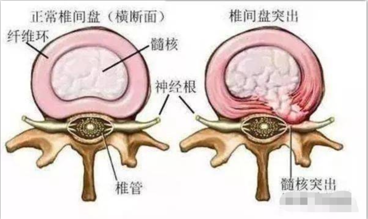 腰突了，最好的医生是自己，学会腰椎伸筋操，腿疼腿麻时候最管用休闲区蓝鸢梦想 - Www.slyday.coM