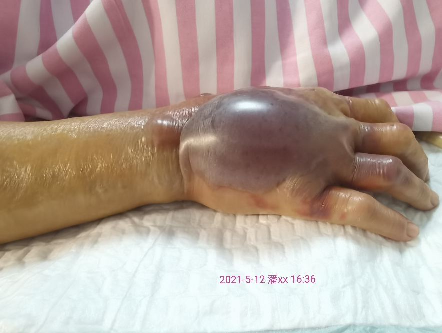 广西一女子被海鲜刺伤,出现休克,呼吸衰竭症状!最后.