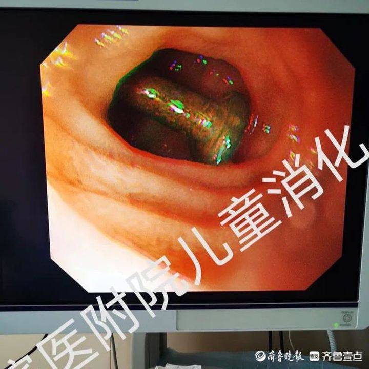 7岁女孩吞下整段火腿肠卡在食道险酿祸端|火腿肠|食道|异物_新浪新闻