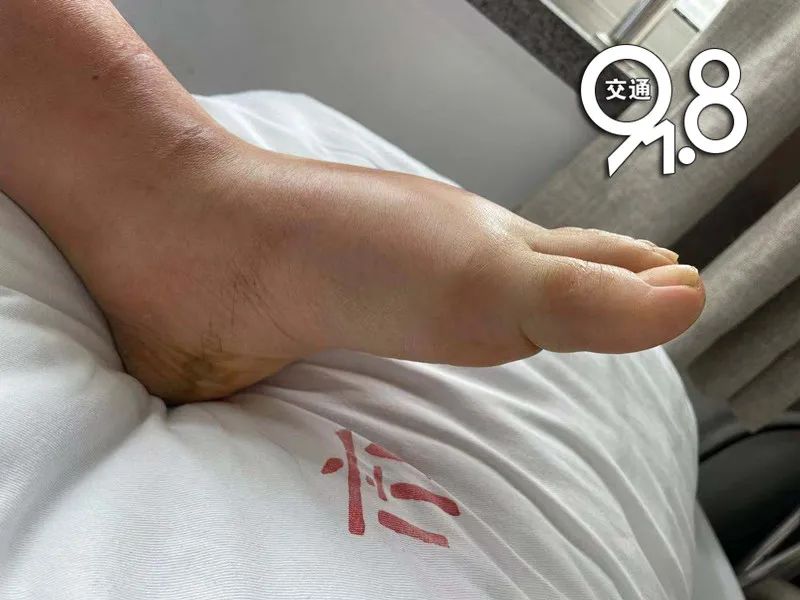 杭州姑娘暴雨里走一趟脚变成这样医生都吓一跳