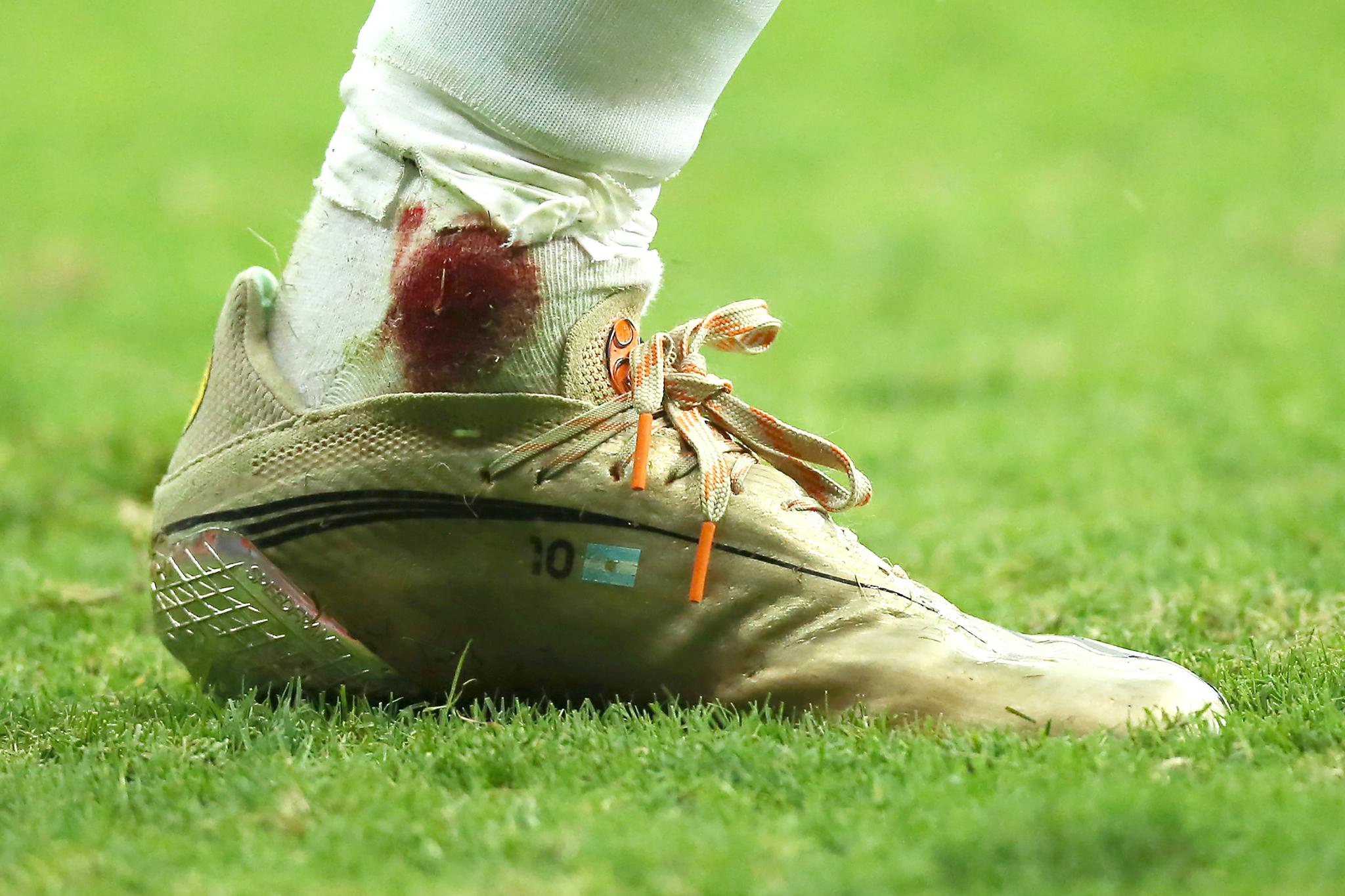 对阵哥伦比亚，梅西脚踝被铲出血。