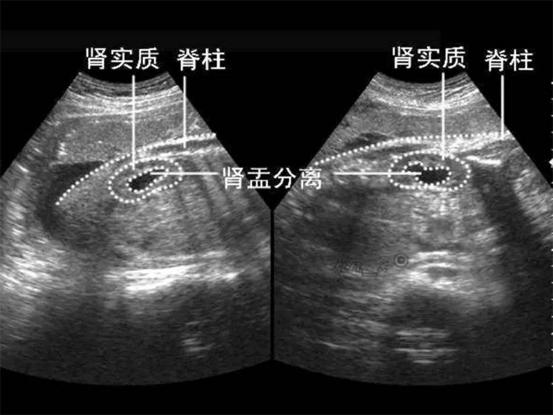 胎儿发育过程中,双侧肾盂分离程度,是会反应出胎儿的泌尿系统发展是否