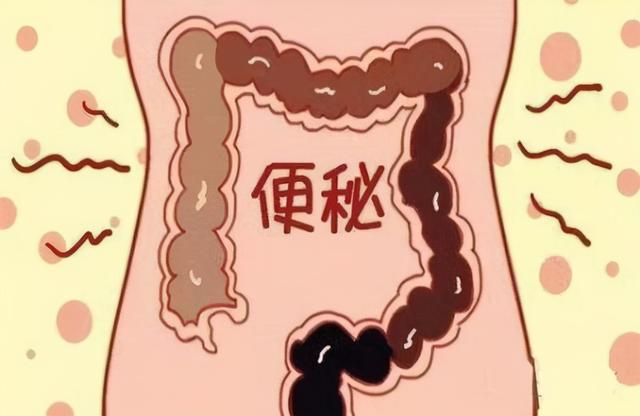 便秘治疗,要避免进入这些误区