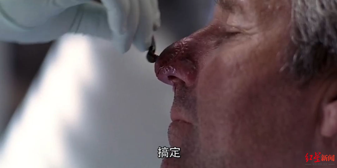 ▲ 经典电视剧《实习医生格蕾》的剧情中，医护将水蛭用于鼻部修复手术后促进微循环