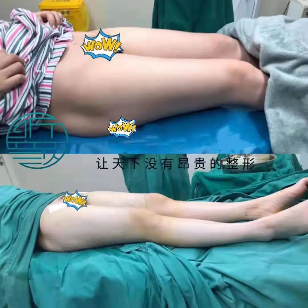 网红去世背后的抽脂生意：“一天五到八台手术”休闲区蓝鸢梦想 - Www.slyday.coM