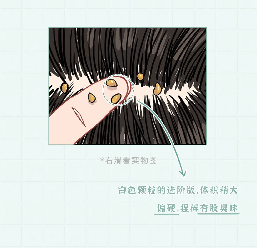 头皮上挠下来的小颗粒到底是啥?看完整个人都不好了