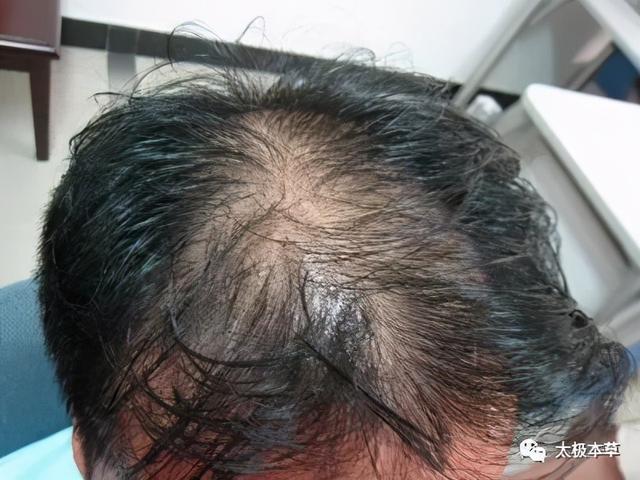 掉头发原因有气血不足,肾精亏虚,头发油多,都有不同的应对措施