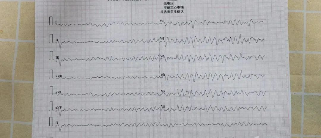 患者突发室颤抢救无效死亡这个病例忽略了什么