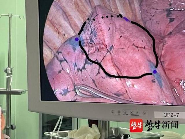 双肺多发磨玻璃结节手术用上gps定位