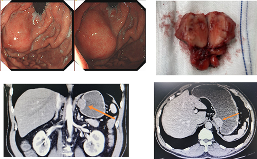 做胃镜发现胃粘膜下鼓起"小球"?需警惕胃间质瘤