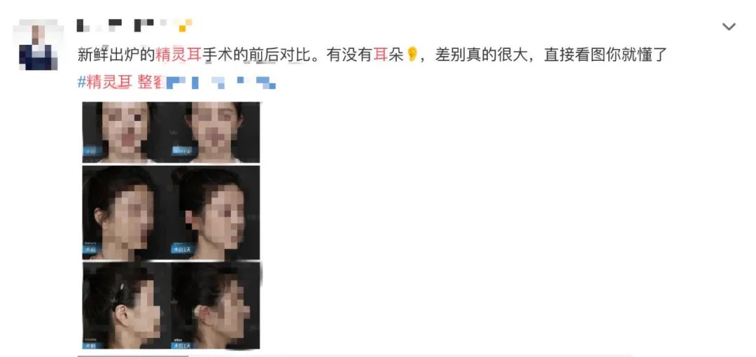显脸小年轻？"精灵耳"整形受追捧，专家：可能显脸更大|整形|玻尿酸_新浪科技_新浪网 - Vimarsana News