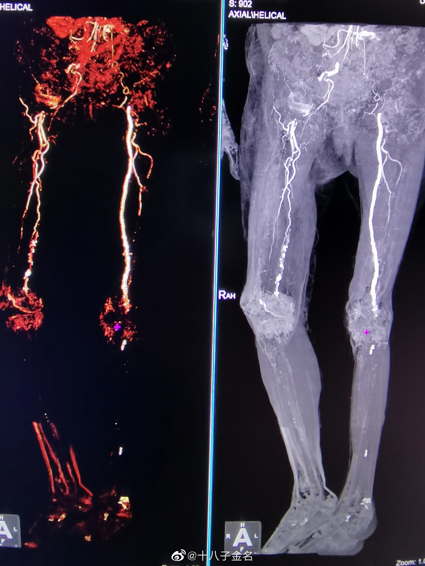 下肢动脉ct成像 人人都避免不了血管硬化……|ct_新浪新闻