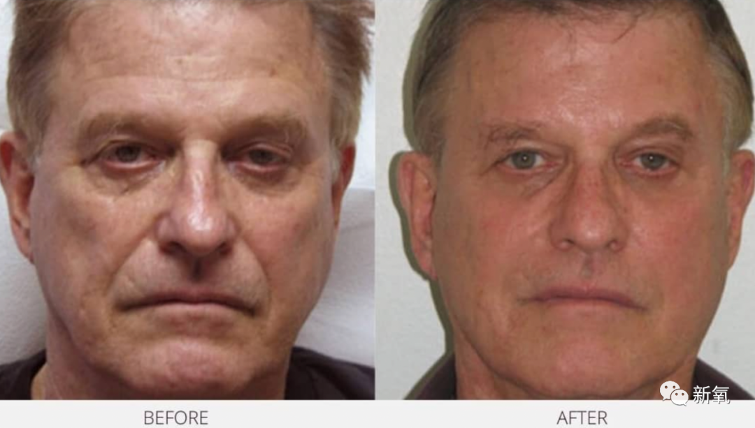 网络上非常悲观的男人面相第二种情况,因为衰老问题而导致的嘴角下垂.