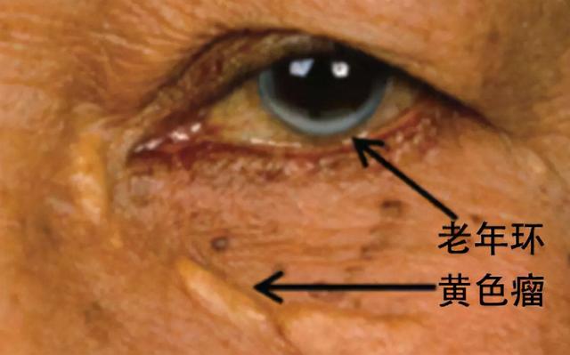 身体四肢皮肤表面或者肌腱部位大多会首先出现,类似于肿瘤样或者斑
