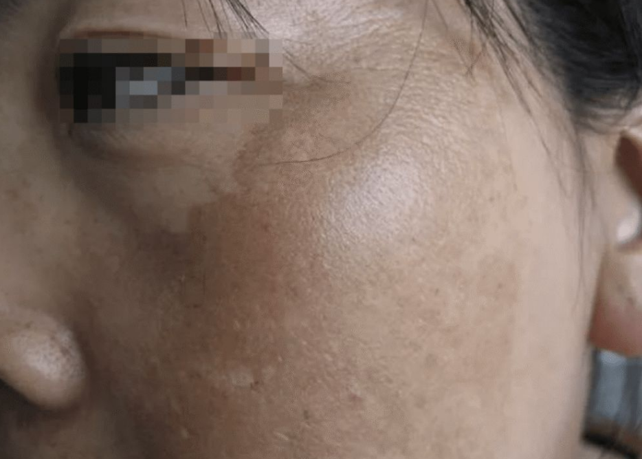 怀孕后或出现三种皮肤变化,最后一种直接老十岁|怀孕|黄褐斑|妊娠纹