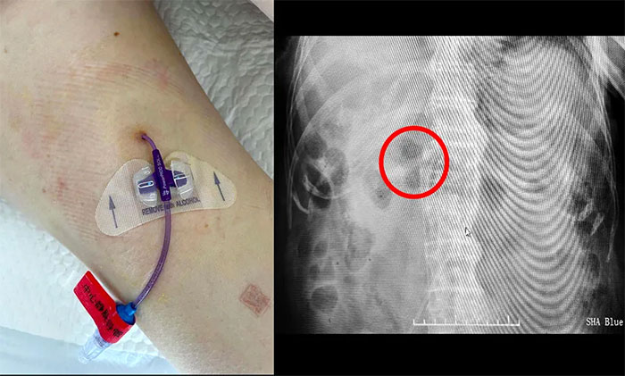 下肢股静脉picc置管术在我院成功开展护理服务水平再上新阶