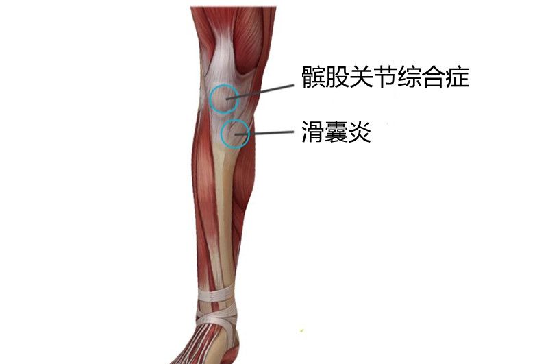 覆盖膝盖内侧部分,当膝盖反复弯曲和伸展导致发炎时,褶皱就会变厚,就