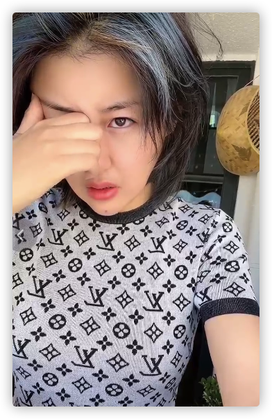 本山传媒娇娇自曝整容晒术后照被指认不出多次割眼皮肿胀明显