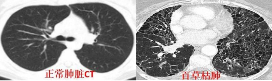被投毒百草枯的18岁女孩：紧急转院，急需肺移植休闲区蓝鸢梦想 - Www.slyday.coM