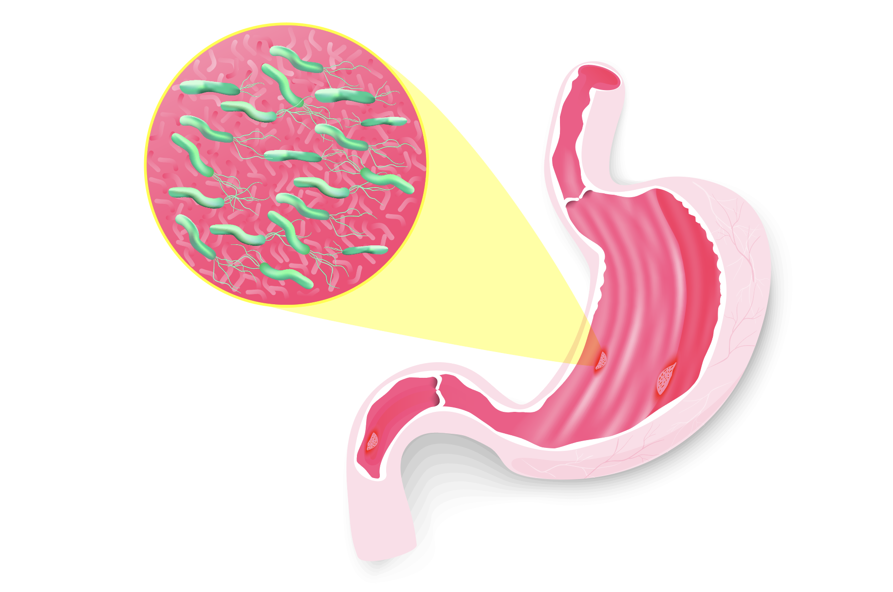 10分钟出结果幽门螺杆菌可验孕棒式检测了