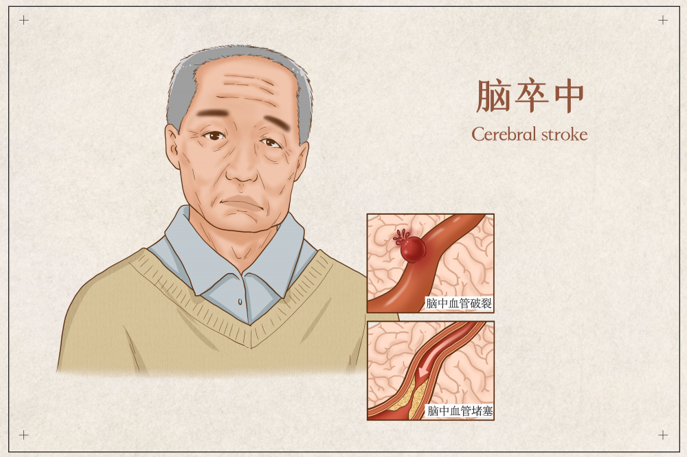 健康科普 |“中风120”三步识别法是什么?专家告诉您|中风_新浪新闻