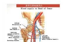 治疗股骨头坏死最治本的方式是什么