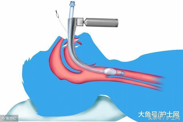PICC导管十二大护理要点|导管|要点|护理_新浪新闻