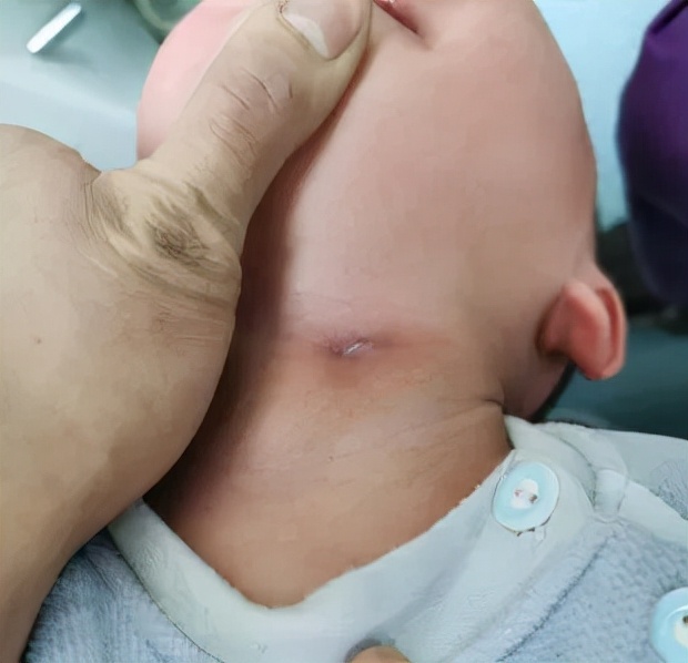 儿童颈部反复感染化脓带你了解先天性梨状窝瘘