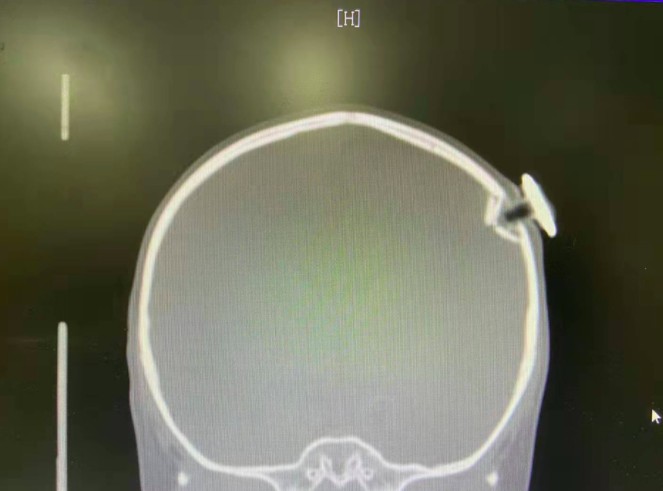 揪心！3岁女童从床上跌落，一颗钉子插入颅内......休闲区蓝鸢梦想 - Www.slyday.coM