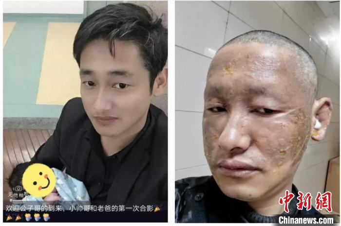 辅警姚森林被烧伤前后对比照. 姚森林 供图