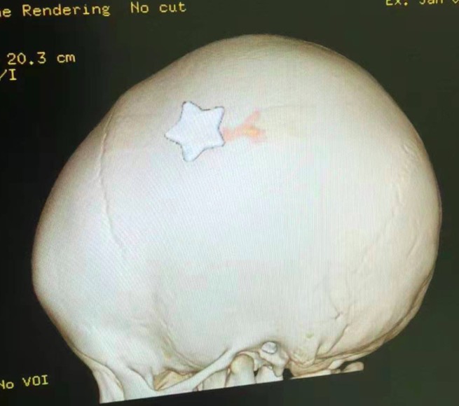 揪心！3岁女童从床上跌落，一颗钉子插入颅内......休闲区蓝鸢梦想 - Www.slyday.coM