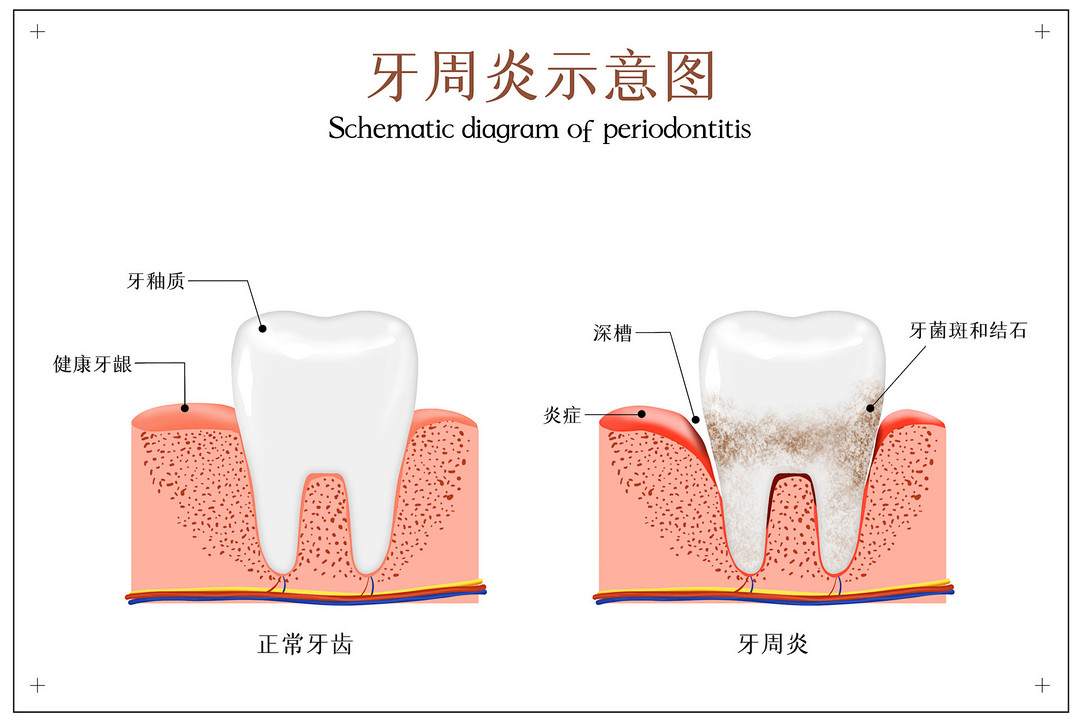 牙周炎|病因|牙齿_新浪新闻