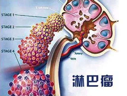 "120万一针"car-t细胞疗法,让复发难治淋巴瘤有治愈希望__财经头条