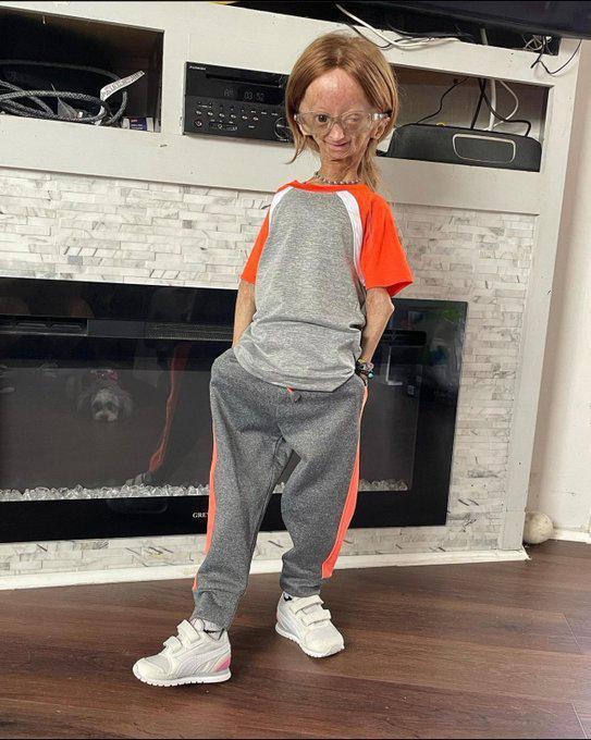 知名网红阿达莉亚·罗斯因早衰症去世,年仅15岁,家人公布死讯|早衰症